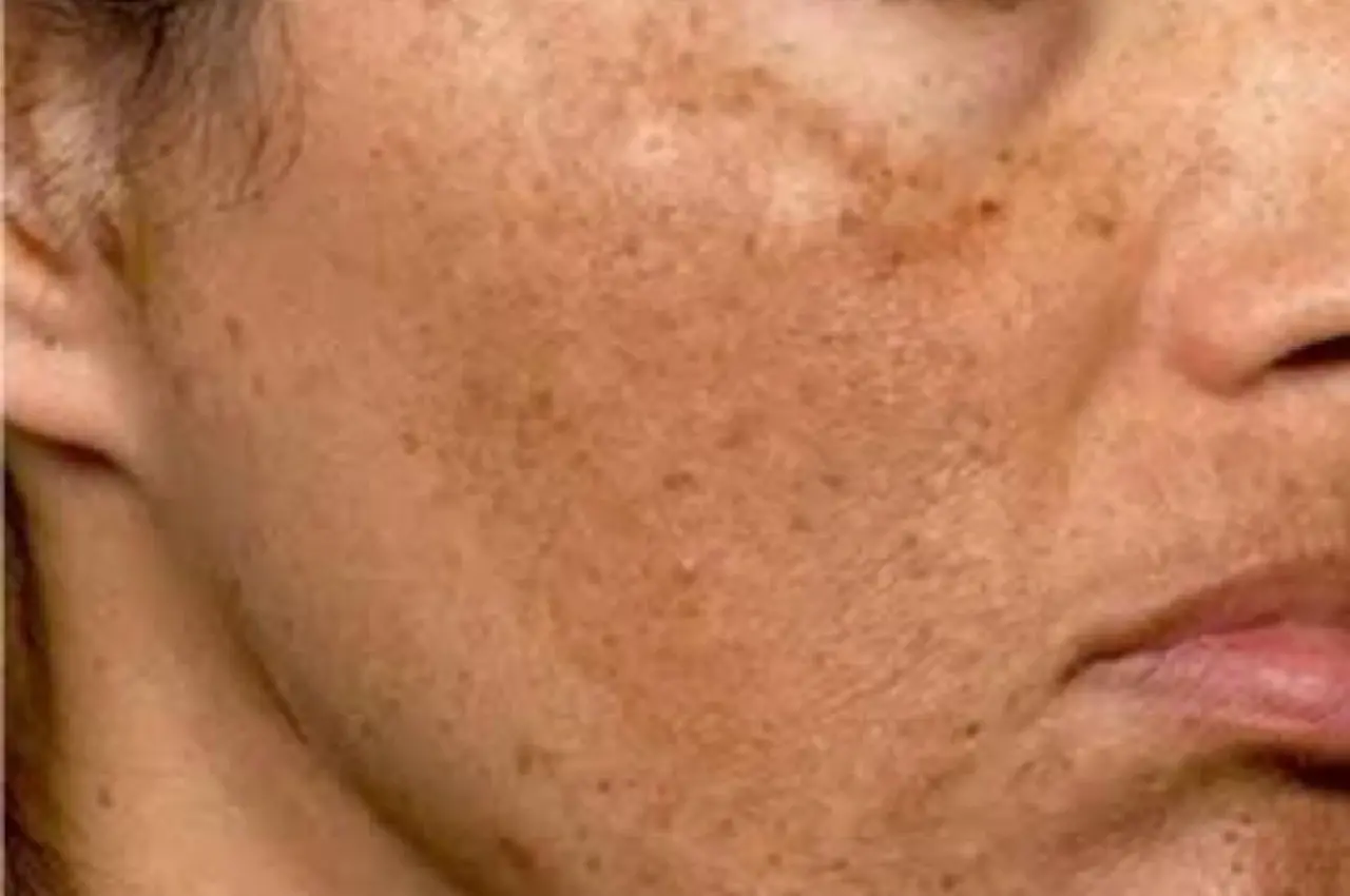 Melasma