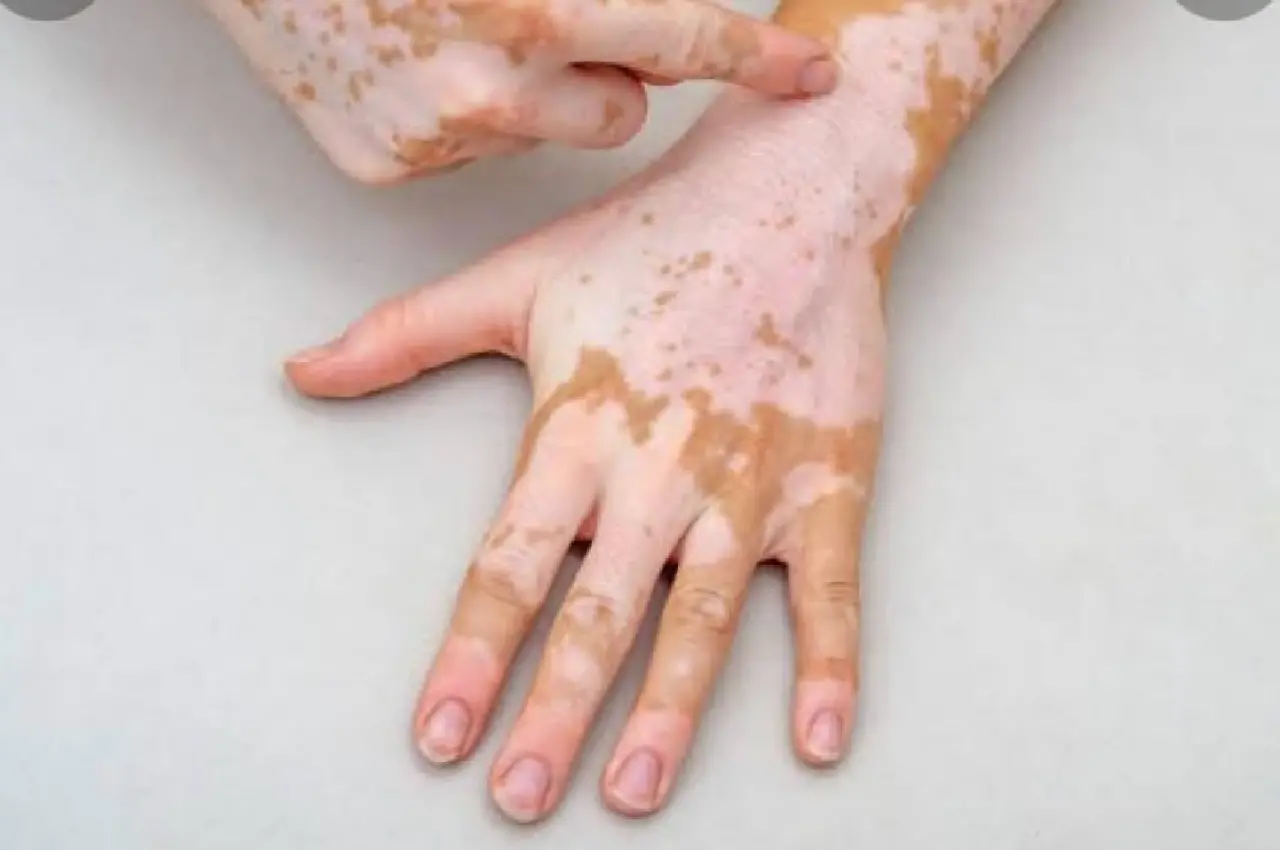 Vitiligo